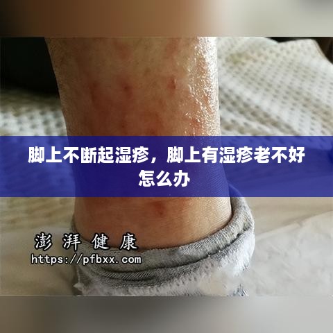 腳上不斷起濕疹，腳上有濕疹老不好怎么辦 